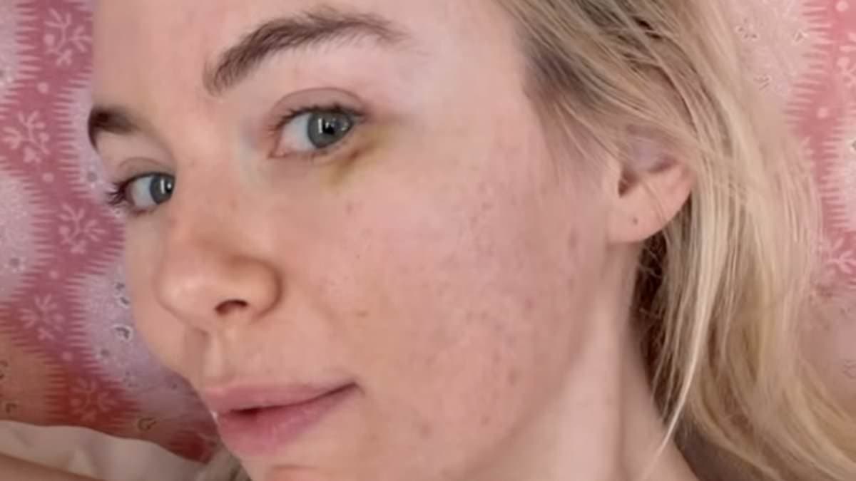 Georgia Toffolo Reveals Bruised Face Following Salmon Sperm Injection Treatment